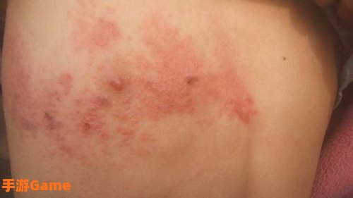 典礼皮缠腰